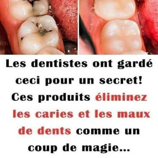 Les dentistes garde ceci secret! Ces produits éliminent les caries et les maux de dents comme un coup de magie…